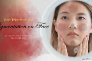 Best Treatment for Pigmentation on Face: Effective Solutions for Flawless Skin